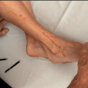 Lyftogt Perineural Injection Treatment: How to Treat Peripheral Nerve Pain 2024