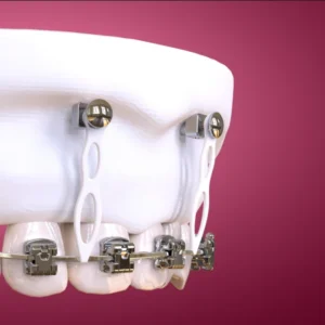 OHI-S Microimplant Anchorage in Clinical Practice: Guide for Beginners and Intermediate