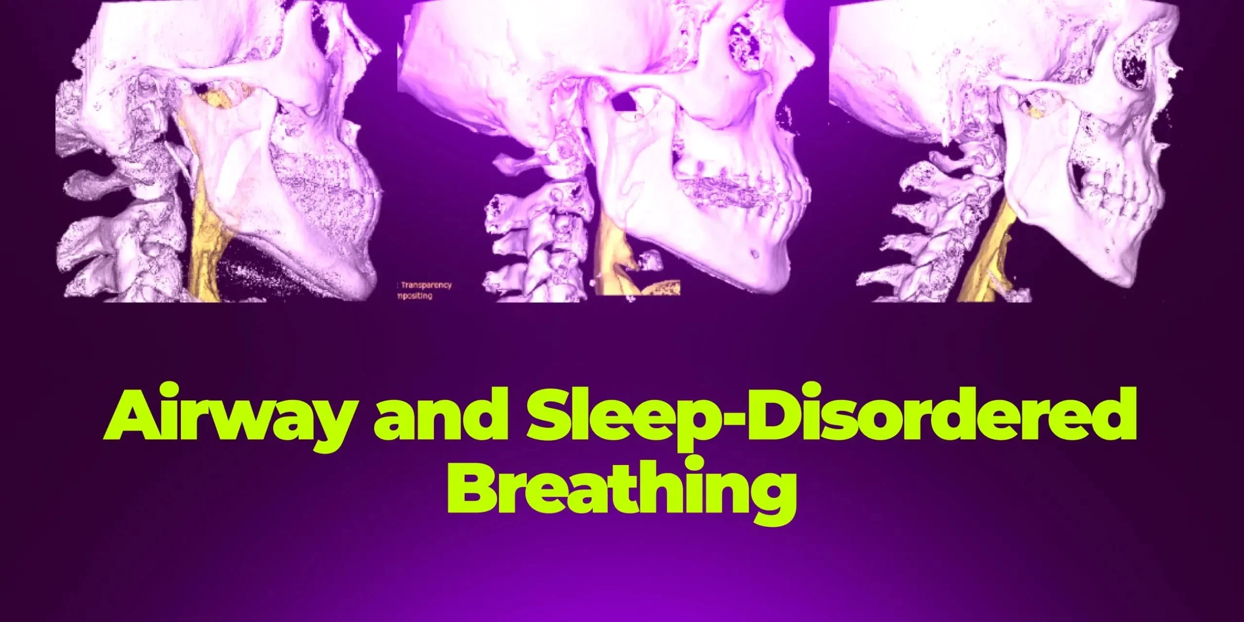 OHI-S Airway and Sleep-Disordered Breathing: Integrating Myofunctional Protocols